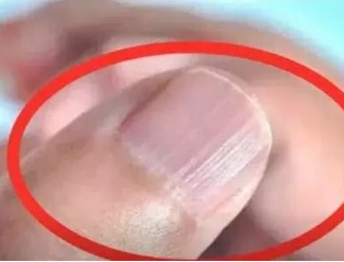 茄子视频黄色下载厂家分析手指甲有竖纹的根本原因 茄子视频黄色下载厂家分析手指甲有竖纹的根本原因